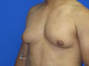 Gynecomastia Before & After Patient #1344