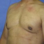 Gynecomastia Before & After Patient #1344