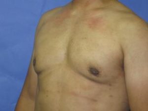 Gynecomastia Before & After Patient #1344