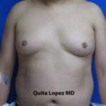 Gynecomastia Before & After Patient #1353