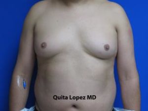 Gynecomastia Before & After Patient #1353