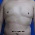 Gynecomastia Before & After Patient #1353