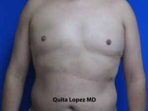 Gynecomastia Before & After Patient #1353