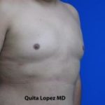 Gynecomastia Before & After Patient #1353