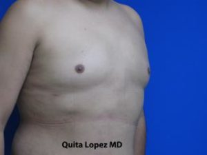 Gynecomastia Before & After Patient #1353