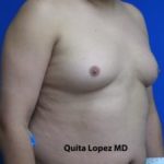 Gynecomastia Before & After Patient #1353