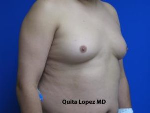 Gynecomastia Before & After Patient #1353