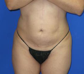 Mini Tummy Tuck Before & After Patient #7310