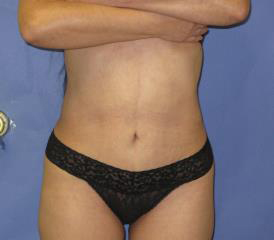 Mini Tummy Tuck Before & After Patient #7310