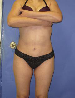 Mini Tummy Tuck Before & After Patient #7310