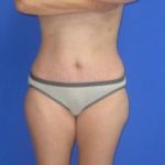 Liposuction Before & After Patient #7315