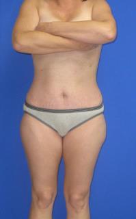 Liposuction Before & After Patient #7315