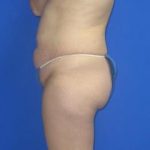 Liposuction Before & After Patient #7315