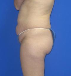 Liposuction Before & After Patient #7315