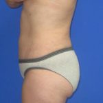 Liposuction Before & After Patient #7315
