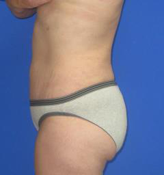 Liposuction Before & After Patient #7315