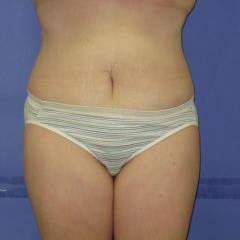 Liposuction Before & After Patient #7320