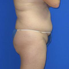 Liposuction Before & After Patient #7320