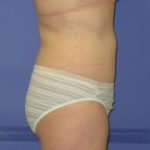 Liposuction Before & After Patient #7320