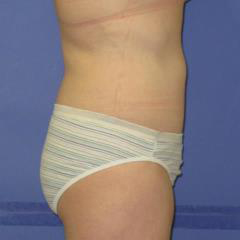 Liposuction Before & After Patient #7320