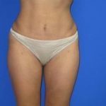 Liposuction Before & After Patient #7325