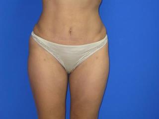 Liposuction Before & After Patient #7325