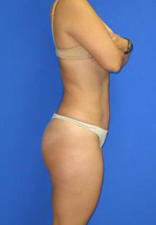 Liposuction Before & After Patient #7325