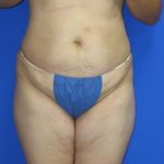 Liposuction Before & After Patient #7330
