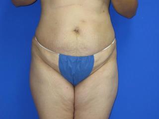 Liposuction Before & After Patient #7330