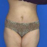 Liposuction Before & After Patient #7330