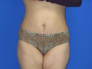 Liposuction Before & After Patient #7330