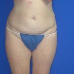 Liposuction Before & After Patient #7335