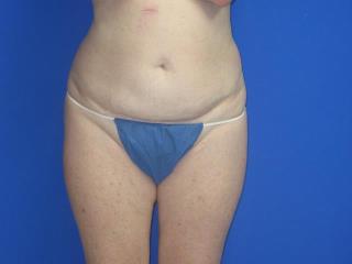 Liposuction Before & After Patient #7335
