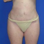 Liposuction Before & After Patient #7335