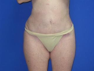 Liposuction Before & After Patient #7335