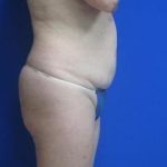 Liposuction Before & After Patient #7335