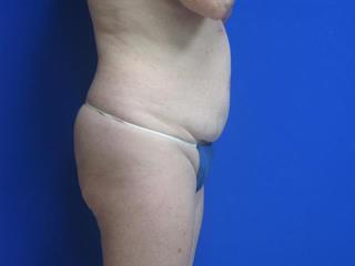 Liposuction Before & After Patient #7335