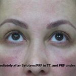 PRP (platelet-rich plasma) / PRF (platelet rich fibrin) Before & After Patient #827