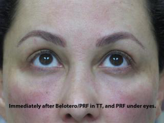 PRP (platelet-rich plasma) / PRF (platelet rich fibrin) Before & After Patient #827