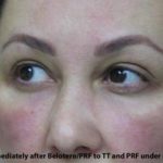 PRP (platelet-rich plasma) / PRF (platelet rich fibrin) Before & After Patient #827