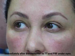 PRP (platelet-rich plasma) / PRF (platelet rich fibrin) Before & After Patient #827