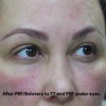 PRP (platelet-rich plasma) / PRF (platelet rich fibrin) Before & After Patient #827