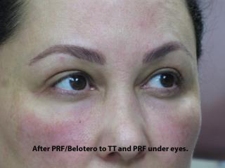 PRP (platelet-rich plasma) / PRF (platelet rich fibrin) Before & After Patient #827