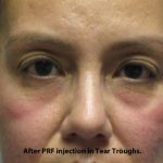 PRP (platelet-rich plasma) / PRF (platelet rich fibrin) Before & After Patient #835