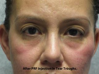 PRP (platelet-rich plasma) / PRF (platelet rich fibrin) Before & After Patient #835