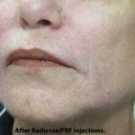 PRP (platelet-rich plasma) / PRF (platelet rich fibrin) Before & After Patient #866