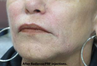 PRP (platelet-rich plasma) / PRF (platelet rich fibrin) Before & After Patient #866