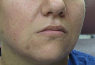 PRP (platelet-rich plasma) / PRF (platelet rich fibrin) Before & After Patient #875