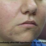 PRP (platelet-rich plasma) / PRF (platelet rich fibrin) Before & After Patient #875