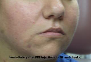 PRP (platelet-rich plasma) / PRF (platelet rich fibrin) Before & After Patient #875